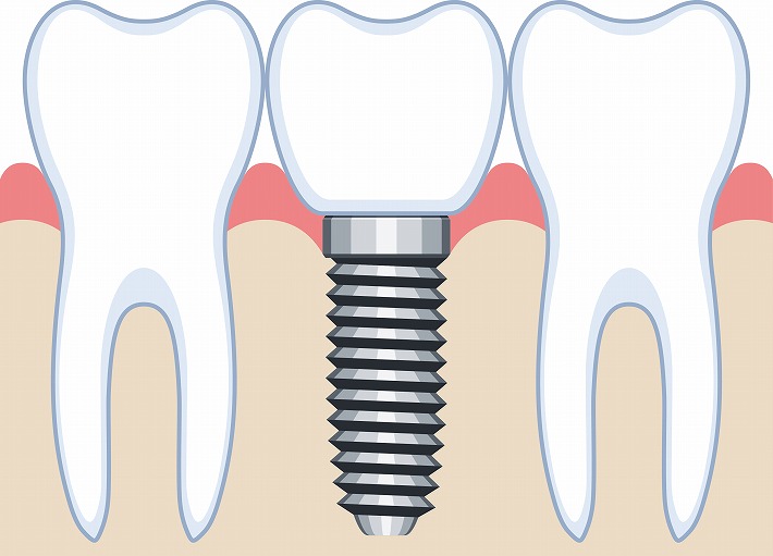 インプラントとは
